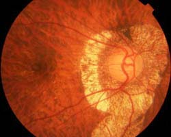 Εκφυλιστική Μυωπία