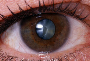 Καταρράκτης Ματιών