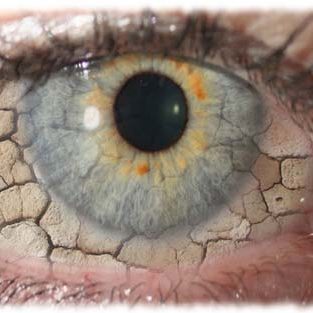 Νόσος Οφθαλμικής Επιφάνειας