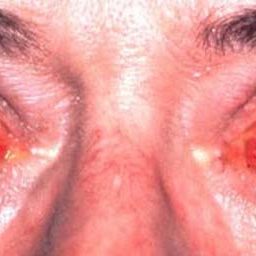 Θυρεοειδική Οφθαλμοπάθεια