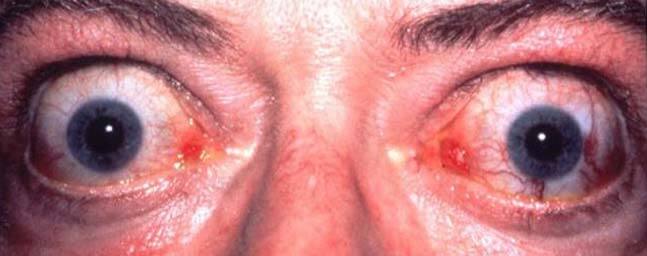 Θυρεοειδική Οφθαλμοπάθεια