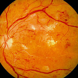 Διαβητική Αμφιβληστροειδοπάθεια