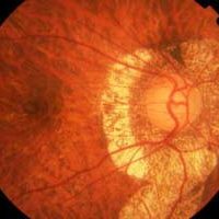 Εκφυλιστική Μυωπία