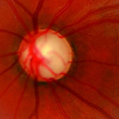 Γλαύκωμα - Τι είναι;