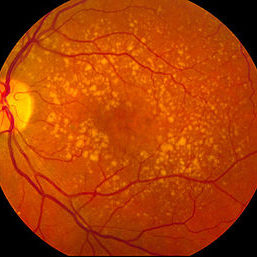 Ηλικιακή Εκφύλιση Ωχράς